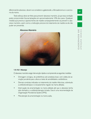 diferencial do abscesso, devem-se considerar a galactocele, a fibroadenoma e o carcino-
ma da mama.                                                                                     47

      Todo esforço deve ser feito para prevenir abscesso mamário, já que essa condição
pode comprometer futuras lactações em aproximadamente 10% dos casos. Qualquer
medida que previna o aparecimento de mastite conseqüentemente vai prevenir o abs-
cesso mamário, assim como a instituição precoce do tratamento da mastite se ela não
puder ser prevenida.

              Abscesso Mamário




                                                                                                        ATENÇÃO BÁSICA
                                                                                          CADERNOS DE
      1.9.10.1 Manejo
      O abscesso mamário exige intervenção rápida e compreende as seguintes medidas:
      •	    Drenagem cirúrgica, de preferência sob anestesia local, com coleta de se-
            creção purulenta para cultura e teste de sensibilidade a antibióticos;
      •	    Demais condutas indicadas no tratamento da mastite infecciosa, sobretudo
            a antibioticoterapia e o esvaziamento regular da mama afetada;
      •	    Interrupção da amamentação na mama afetada até que o abscesso tenha
            sido drenado e a antibioticoterapia iniciada. Essa é uma recomendação da
            Organização Mundial da Saúde (OMS);
      •	    Manutenção da amamentação na mama sadia.
 