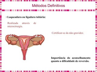 Métodos Definitivos
• Laqueadura ou ligadura tubária:
Realizada através de
microcirurgia.
Importância do aconselhamento
quanto a dificuldade de reversão.
Certificar-se da não-gravidez.
 