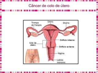 Câncer de colo de útero
 