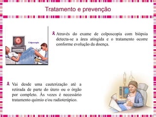 Tratamento e prevenção
Através do exame de colposcopia com biópsia
detecta-se a área atingida e o tratamento ocorre
conforme evolução da doença.
Vai desde uma cauterização até a
retirada de parte do útero ou o órgão
por completo. Às vezes é necessário
tratamento quimio e/ou radioterápico.
 