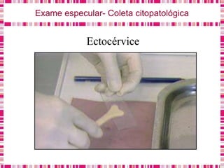Exame especular- Coleta citopatológica
Ectocérvice
 