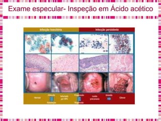 Exame especular- Inspeção em Ácido acético
 