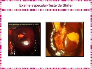 Exame especular-Teste de Shiller
 
