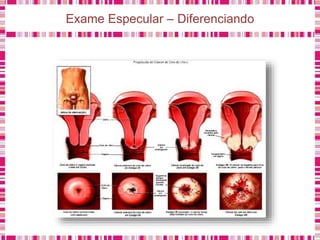 Exame Especular – Diferenciando
 