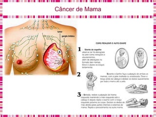Câncer de Mama
 