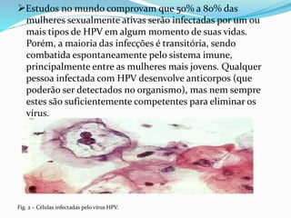 Estudos no mundo comprovam que 50% a 80% das
mulheres sexualmente ativas serão infectadas por um ou
mais tipos de HPV em algum momento de suas vidas.
Porém, a maioria das infecções é transitória, sendo
combatida espontaneamente pelo sistema imune,
principalmente entre as mulheres mais jovens. Qualquer
pessoa infectada com HPV desenvolve anticorpos (que
poderão ser detectados no organismo), mas nem sempre
estes são suficientemente competentes para eliminar os
vírus.
Fig. 2 – Células infectadas pelo vírus HPV.
 