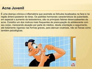 Acne Juvenil
É uma doença crônica e inflamatória que acomete os folículos localizados na face e na
região ântero-posterior do tórax. Os padrões hormonais característicos da puberdade,
em especial o aumento da testosterona, são os principais fatores desencadeantes da
acne. Constitui um dos motivos mais frequentes de preocupação do adolescente com
seu corpo, merecendo atuação por parte do médico, desde orientação e seguimento,
até tratamento vigoroso nas formas graves, para atenuar cicatrizes, não só físicas como
também psicológicas.

 