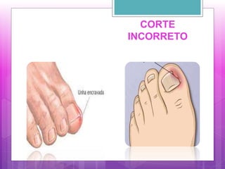 CORTE
INCORRETO
 