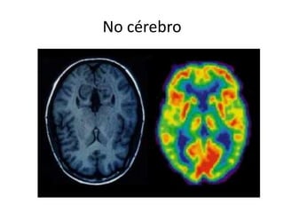 No cérebro
 