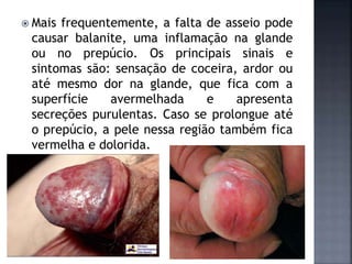  Mais frequentemente, a falta de asseio pode
causar balanite, uma inflamação na glande
ou no prepúcio. Os principais sinais e
sintomas são: sensação de coceira, ardor ou
até mesmo dor na glande, que fica com a
superfície avermelhada e apresenta
secreções purulentas. Caso se prolongue até
o prepúcio, a pele nessa região também fica
vermelha e dolorida.
 