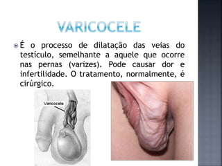  É o processo de dilatação das veias do
testículo, semelhante a aquele que ocorre
nas pernas (varizes). Pode causar dor e
infertilidade. O tratamento, normalmente, é
cirúrgico.
 