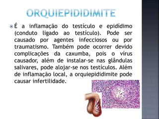  É a inflamação do testículo e epidídimo
(conduto ligado ao testículo). Pode ser
causado por agentes infecciosos ou por
traumatismo. Também pode ocorrer devido
complicações da caxumba, pois o vírus
causador, além de instalar-se nas glândulas
salivares, pode alojar-se nos testículos. Além
de inflamação local, a orquiepididimite pode
causar infertilidade.
 