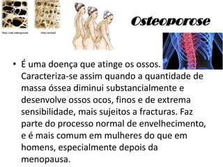Osteoporose
• É uma doença que atinge os ossos.
Caracteriza-se assim quando a quantidade de
massa óssea diminui substancialmente e
desenvolve ossos ocos, finos e de extrema
sensibilidade, mais sujeitos a fracturas. Faz
parte do processo normal de envelhecimento,
e é mais comum em mulheres do que em
homens, especialmente depois da
menopausa.
 