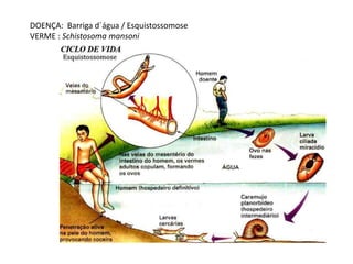 DOENÇA: Barriga d´água / Esquistossomose
VERME : Schistosoma mansoni
 