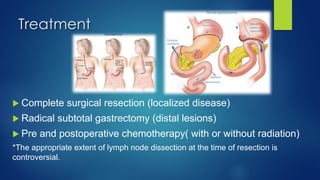 Treatment
u Complete surgical resection (localized disease)
u Radical subtotal gastrectomy (distal lesions)
u Pre and postoperative chemotherapy( with or without radiation)
*The appropriate extent of lymph node dissection at the time of resection is
controversial.
 