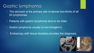 Gastric lymphoma
! The stomach is the primary site of almost two-thirds of all
GI lymphomas.
! Patients with gastric lymphoma tend to be older.
! Gastric lymphoma usually is non-Hodgkin’s.
! Endoscopy with tissue biopsies provides the diagnosis.
 