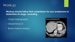 Workup
Workup should follow that undertaken for any lymphoma to
determine its stage, including :
ü Chest radiography
ü Abdominal CT
ü Bone marrow biopsy
 