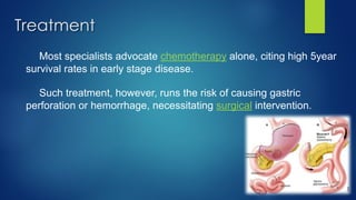 Treatment
Most specialists advocate chemotherapy alone, citing high 5year
survival rates in early stage disease.
Such treatment, however, runs the risk of causing gastric
perforation or hemorrhage, necessitating surgical intervention.
 