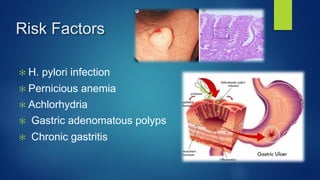 Risk Factors
✻ H. pylori infection
✻ Pernicious anemia
✻ Achlorhydria
✻ Gastric adenomatous polyps
✻ Chronic gastritis
 