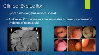 Clinical Evaluation
→ upper endoscopy(submucosal mass)
→ Abdominal CT (determines the tumor size & presence of invasion,
evidence of metastasis)
 
