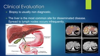 ✧ Biopsy is usually non diagnostic.
✧ The liver is the most common site for disseminated disease.
Spread to lymph nodes occurs infrequently.
Clinical Evaluation
 