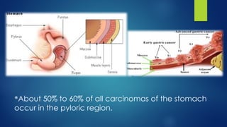 *About 50% to 60% of all carcinomas of the stomach
occur in the pyloric region.
 