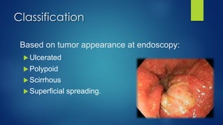 Classification
Based on tumor appearance at endoscopy:
u Ulcerated
u Polypoid
u Scirrhous
u Superficial spreading.
 