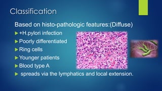 Based on histo-pathologic features:(Diffuse)
u +H.pylori infection
u Poorly differentiated
u Ring cells
u Younger patients
u Blood type A
u spreads via the lymphatics and local extension.
Classification
 