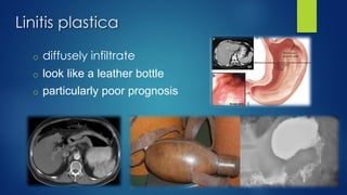Linitis plastica
o diffusely infiltrate
o look like a leather bottle
o particularly poor prognosis
 