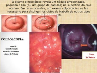 O exame ginecológico revela um nódulo arredondado,
pequeno e liso (ou um grupo de nódulos) na superfície do colo
uterino. Em raras ocasiões, um exame colposcópico se faz
necessário para distinguir os cistos de Naboth de outros tipos
de lesões cervicais.
 