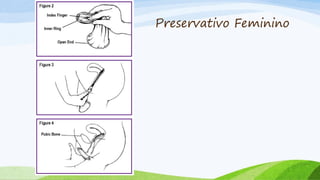 Preservativo Feminino
 