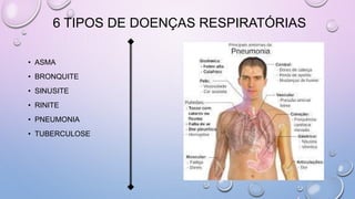6 TIPOS DE DOENÇAS RESPIRATÓRIAS
• ASMA
• BRONQUITE
• SINUSITE
• RINITE
• PNEUMONIA
• TUBERCULOSE
 