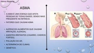 ASMA
• A ASMA É UMA DOENÇA QUE AFETA
PESSOAS DE TODAS IDADES, SENDO MAIS
FREQÜENTE NA INFÂNCIA.
• FATORES QUE CAUSAM ASMA
• ALÉRGICOS (ALIMENTOS QUE CAUSAM
IRRITAÇÃO, ALERGIA);
• AGENTES IRRITANTES (CIGARRO, CHEIROS
FORTES);
• POLUIÇÃO DO AR;
• ALTERNÂNCIA DE CLIMAS;
• GENÉTICO.
Hádron Riquelme
 