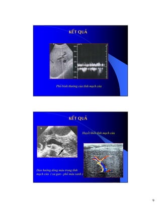 9
Phổ bình thường của tĩnh mạch cửa
KEKEÁÁT QUAT QUAÛÛ
Huyết khối tĩnh mạch cửa
Đảo hướng dòng máu trong tĩnh
mạch cửa ( xa gan - phổ màu xanh )
KEKEÁÁT QUAT QUAÛÛ
 