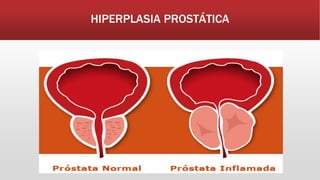HIPERPLASIA PROSTÁTICA
 