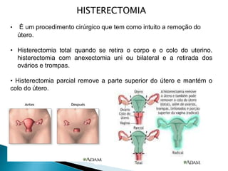 HISTERECTOMIA
• É um procedimento cirúrgico que tem como intuito a remoção do
útero.
• Histerectomia total quando se retira o corpo e o colo do uterino.
histerectomia com anexectomia uni ou bilateral e a retirada dos
ovários e trompas.
• Histerectomia parcial remove a parte superior do útero e mantém o
colo do útero.
 