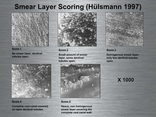 Smear Layer Scoring (Hülsmann 1997) Score 1 No smear layer, dentinal tubules open. Score 2 Small amount of smear layer, some dentinal tubules open. Score 3 Homogenous smear layer, only few dentinal tubules open.  Score 4 Complete root canal covered, no open dentinal tubules. Score 5 Heavy, non homogenous smear layer covering the complete root canal wall. X 1000 
