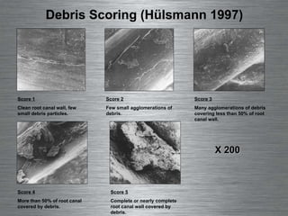 Debris Scoring (Hülsmann 1997) Score 1 Clean root canal wall, few small debris particles. Score 2 Few small agglomerations of debris. Score 3 Many agglomerations of debris covering less than 50% of root canal wall. Score 4 More than 50% of root canal covered by debris. Score 5 Complete or nearly complete root canal wall covered by debris.  X 200 