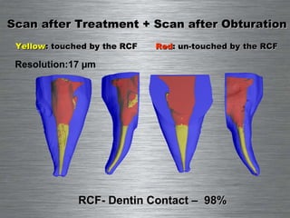 RCF- Dentin Contact –  98% Scan after Treatment + Scan after Obturation Yellow : touched by the RCF Red : un-touched by the RCF Resolution:17 µm 