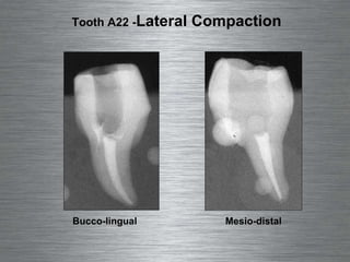 Tooth A22 -  Lateral Compaction Bucco-lingual Mesio-distal 