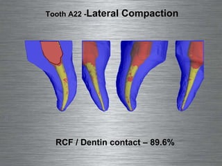 RCF / Dentin contact – 89.6%  Tooth A22 -  Lateral Compaction 