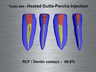RCF / Dentin contact –  98.6%  Tooth A04 –  Heated Gutta-Percha Injection 