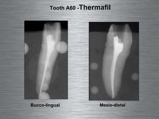 Bucco-lingual Mesio-distal Tooth A60 -  Thermafil 