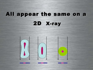 All appear the same on a  2D  X-ray 