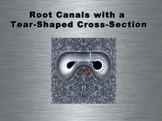 Root Canals with a  Tear-Shaped Cross-Section 