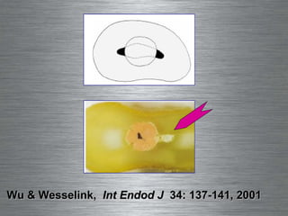 Wu & Wesselink,  Int Endod J   34: 137-141, 2001 