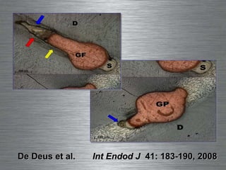 De Deus et al.  Int Endod J   41: 183-190, 2008 