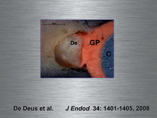 De Deus et al.  J Endod   34: 1401-1405, 2008 