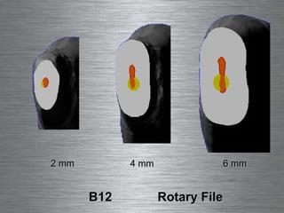 B12  Rotary File 2 mm 4 mm 6 mm 
