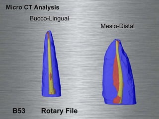 B53  Rotary File Micro CT Analysis Bucco-Lingual Mesio-Distal 